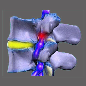 Nerve root compression