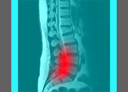 spinal stenosis lower back