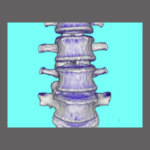 Compression Fracture Spinal Stenosis