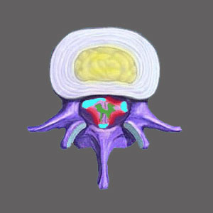 Hereditary Spinal Stenosis