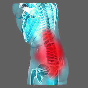 Spinal cord impingement