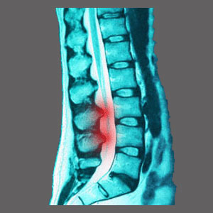 Spinal Stenosis Prescription
