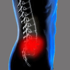 Spinal Stenosis Presentation