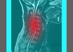 spinal stenosis neck